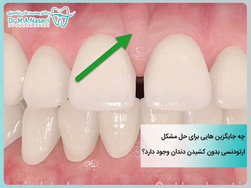 روش های جایگزین کشیدن دندان در ارتودنسی
