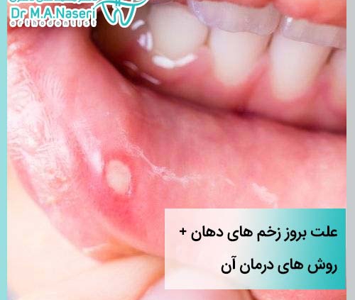 علت بروز زخم های دهان